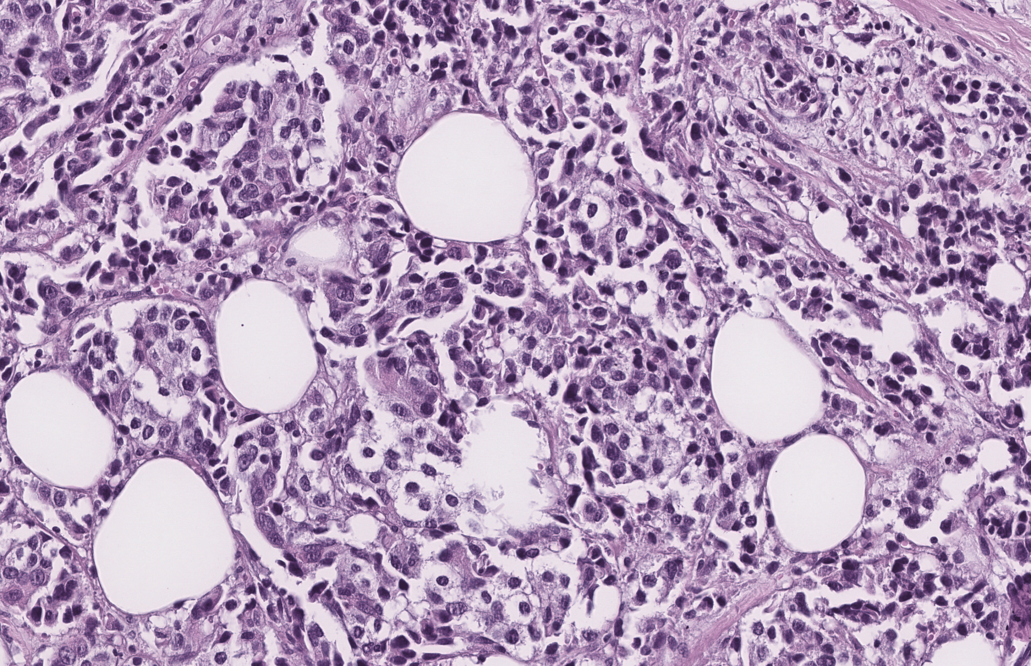 Graph-BRACS teaser – cell-graph construction from a histopathology ROI